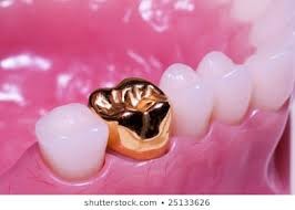 تاج طلایی جای کامپوزیت یا پرسلن